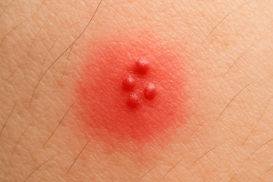 silverfish-bite-look-like